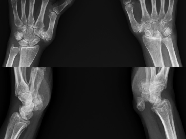 Figure 5 for case Lunate dislocation